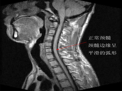 颈椎病的预防方法-合肥同仁医院